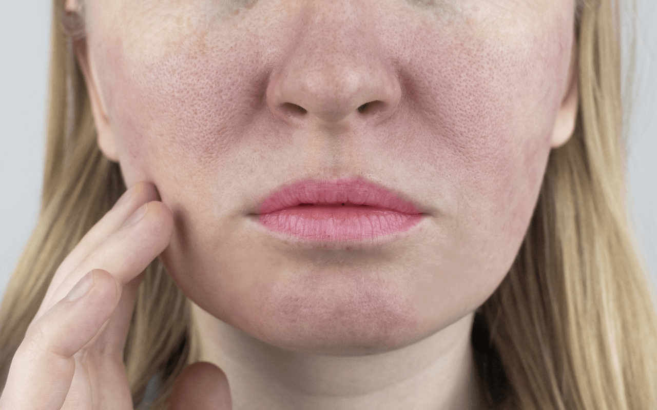 Pielęgnacja cery naczynkowej